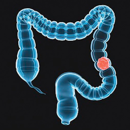 Непрохідність і перфорація при колоректальному раку - два найбільш серйозних ускладнення, що вимагають особливої ​​уваги при виробленні стратегії і тактики на етапі встановлення діагнозу і прийняття своєчасного рішення для надання дієвої допомоги хворим онкологічного профілю