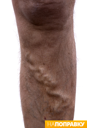 Як правило, варикозні вени мають темно-фіолетовий або синій колір, вони звивисті або виступають над поверхнею шкіри