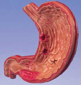 Виразкова хвороба - це виразки на слизовій шлунка, стравоходу або тонкого кишечника