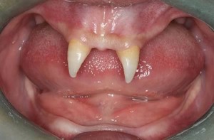 У китайського хлопчика виросло два дуже гострих передніх зуба, в результаті чого він став схожий на вампіра
