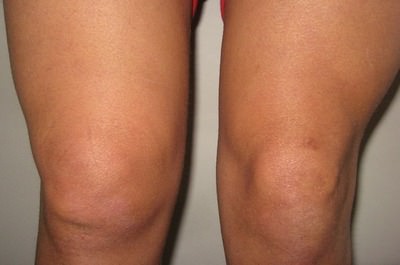 Подивіться на фото, як виглядає синовит колінного суглоба