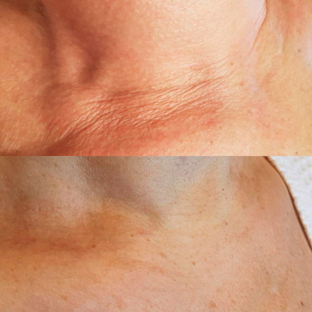 Як позбутися від зморшок на шиї (через 2 місяці після процедури, жінка 50+)